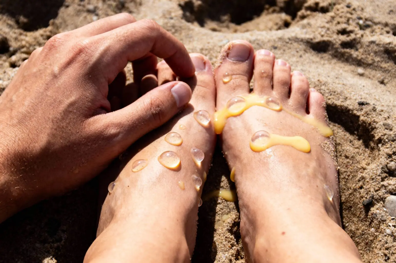 eczema bulleux