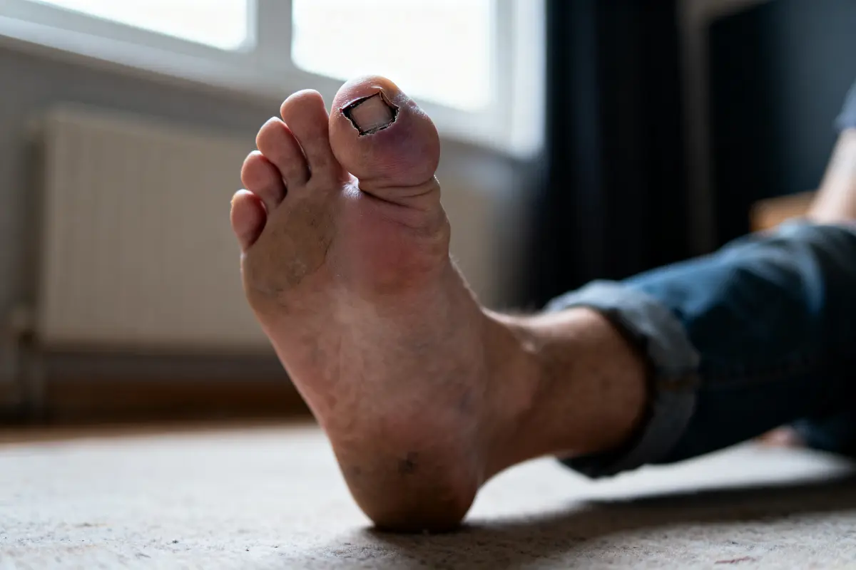 Pied humain avec gros orteil meurtri et ongle partiellement détaché, à l'intérieur d'une pièce.