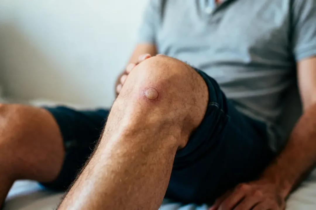 Personne assise avec un bandage au genou se repose ou pas avec un kyste poplité